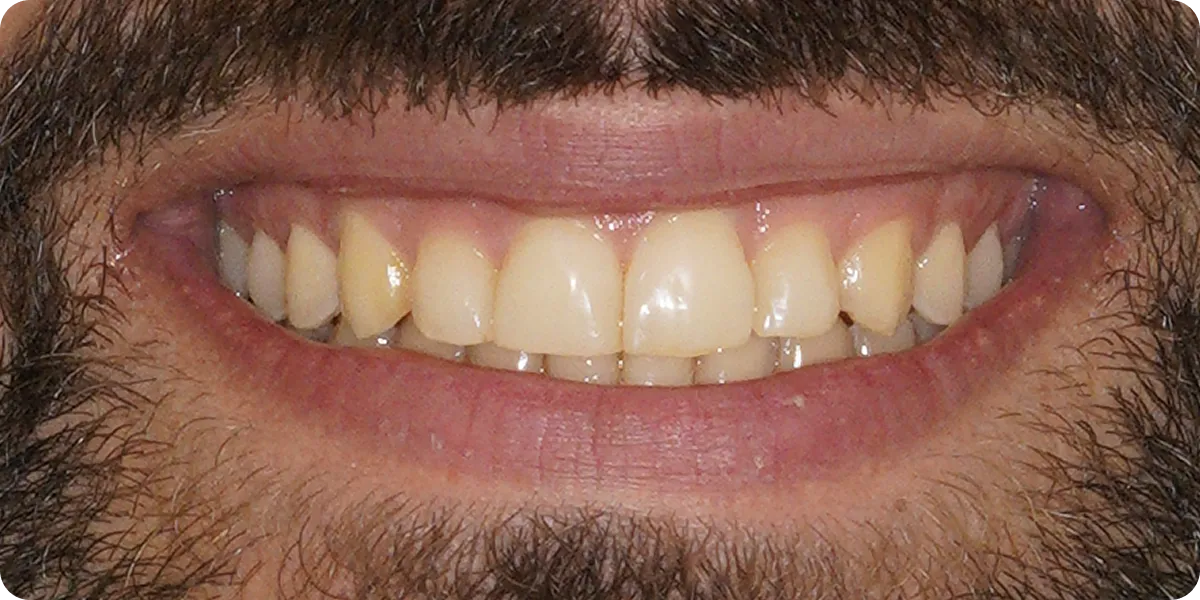 Dopo: Allineatori Invisalign e composite bonding: sorriso prima e dopo il trattamento