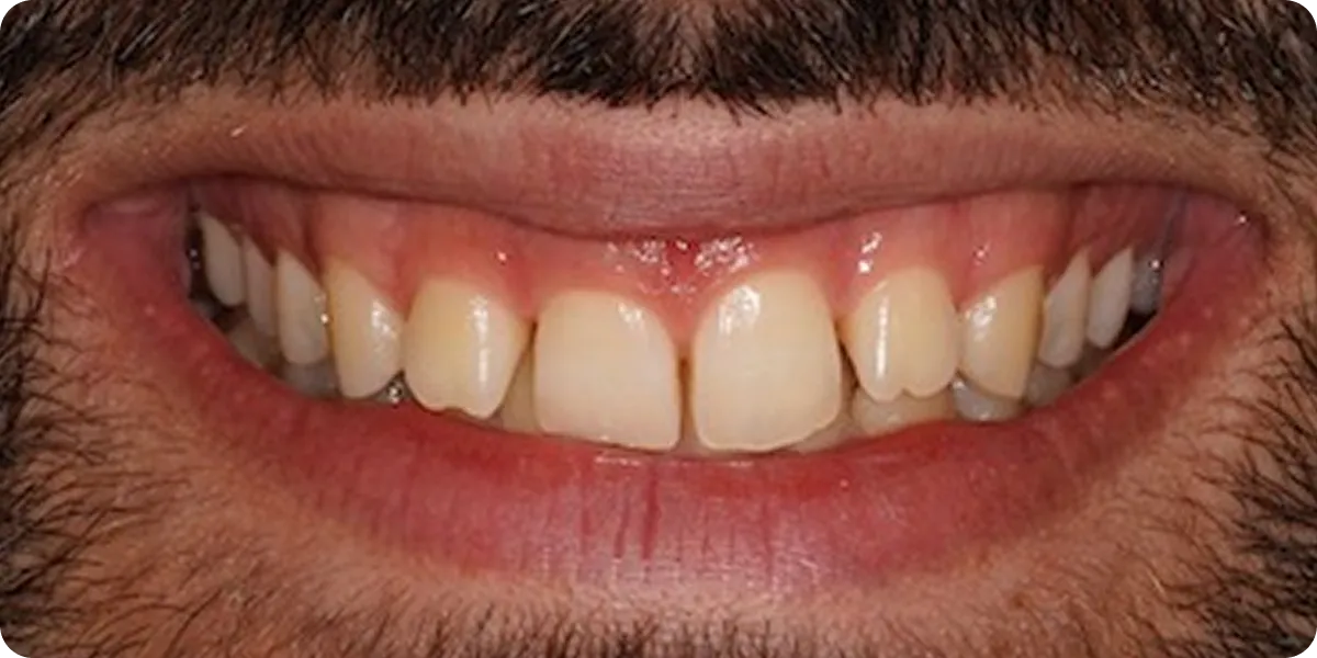 Prima: Allineatori Invisalign e composite bonding: sorriso prima e dopo il trattamento