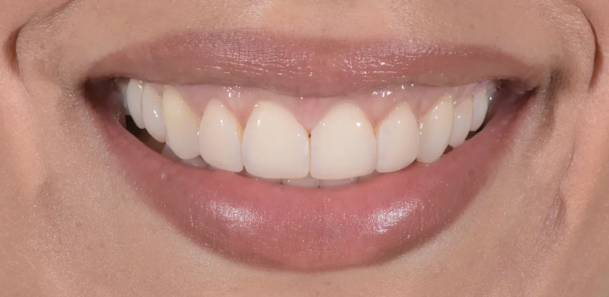 Dopo: Sbiancamento: sorriso prima e dopo il trattamento