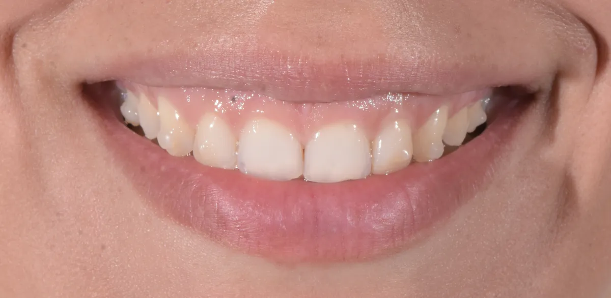 Prima: Sbiancamento: sorriso prima e dopo il trattamento